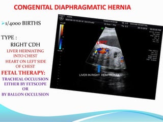 CONGENITAL DIAPHRAGMATIC HERNIA
1/4000 BIRTHS
TYPE :
RIGHT CDH
LIVER HERNIATING
INTO CHEST
HEART ON LEFT SIDE
OF CHEST
FETAL THERAPY:
TRACHEAL OCCLUSION
EITHER BY FETSCOPE
OR
BY BALLON OCCLUSION
HEART RIGHT HEMITHORAX LEFT
LIVER IN RIGHT HEMITHORAX
 