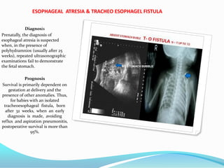 ESOPHAGEAL ATRESIA & TRACHEO ESOPHAGEL FISTULA
Diagnosis
Prenatally, the diagnosis of
esophageal atresia is suspected
when, in the presence of
polyhydramnios (usually after 25
weeks), repeated ultrasonographic
examinations fail to demonstrate
the fetal stomach.
Prognosis
Survival is primarily dependent on
gestation at delivery and the
presence of other anomalies. Thus,
for babies with an isolated
tracheoesophageal fistula, born
after 32 weeks, when an early
diagnosis is made, avoiding
reflux and aspiration pneumonitis,
postoperative survival is more than
95%.
RK
LK
NO STOMACH BUBBLE
 