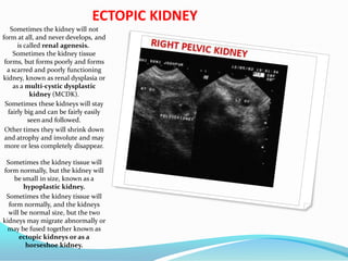 ECTOPIC KIDNEY
Sometimes the kidney will not
form at all, and never develops, and
is called renal agenesis.
Sometimes the kidney tissue
forms, but forms poorly and forms
a scarred and poorly functioning
kidney, known as renal dysplasia or
as a multi-cystic dysplastic
kidney (MCDK).
Sometimes these kidneys will stay
fairly big and can be fairly easily
seen and followed.
Other times they will shrink down
and atrophy and involute and may
more or less completely disappear.
Sometimes the kidney tissue will
form normally, but the kidney will
be small in size, known as a
hypoplastic kidney.
Sometimes the kidney tissue will
form normally, and the kidneys
will be normal size, but the two
kidneys may migrate abnormally or
may be fused together known as
ectopic kidneys or as a
horseshoe kidney.
 