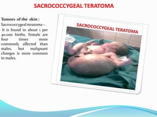 SACROCOCCYGEAL TERATOMA
Tumors of the skin :
Sacrococcygeal teratoma –
It is found in about 1 per
40.000 births. Female are
four times more
commonly affected than
males, but malignant
changes is more common
in males.
 
