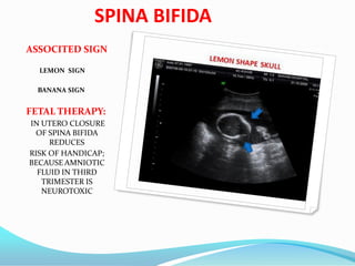 SPINA BIFIDA
ASSOCITED SIGN
LEMON SIGN
BANANA SIGN
FETAL THERAPY:
IN UTERO CLOSURE
OF SPINA BIFIDA
REDUCES
RISK OF HANDICAP;
BECAUSE AMNIOTIC
FLUID IN THIRD
TRIMESTER IS
NEUROTOXIC
 