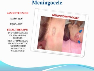 Meningocele
ASSOCITED SIGN
LEMON SIGN
BANANA SIGN
FETAL THERAPY:
IN UTERO CLOSURE
OF SPINA BIFIDA
REDUCES
RISK OF HANDICAP;
BECAUSE AMNIOTIC
FLUID IN THIRD
TRIMESTER IS
NEUROTOXIC
 