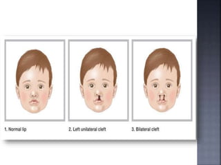 Birth defects | PPTX