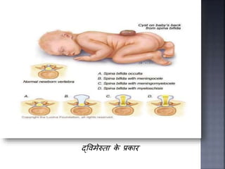 Birth defects | PPTX