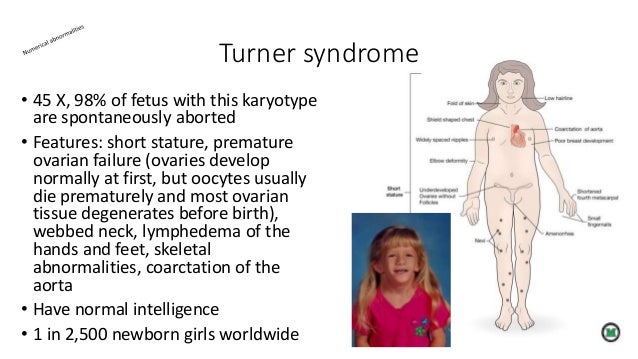 characteristics history and affects of the xyy syndrome characteristics history and affects of the xyy syndrome