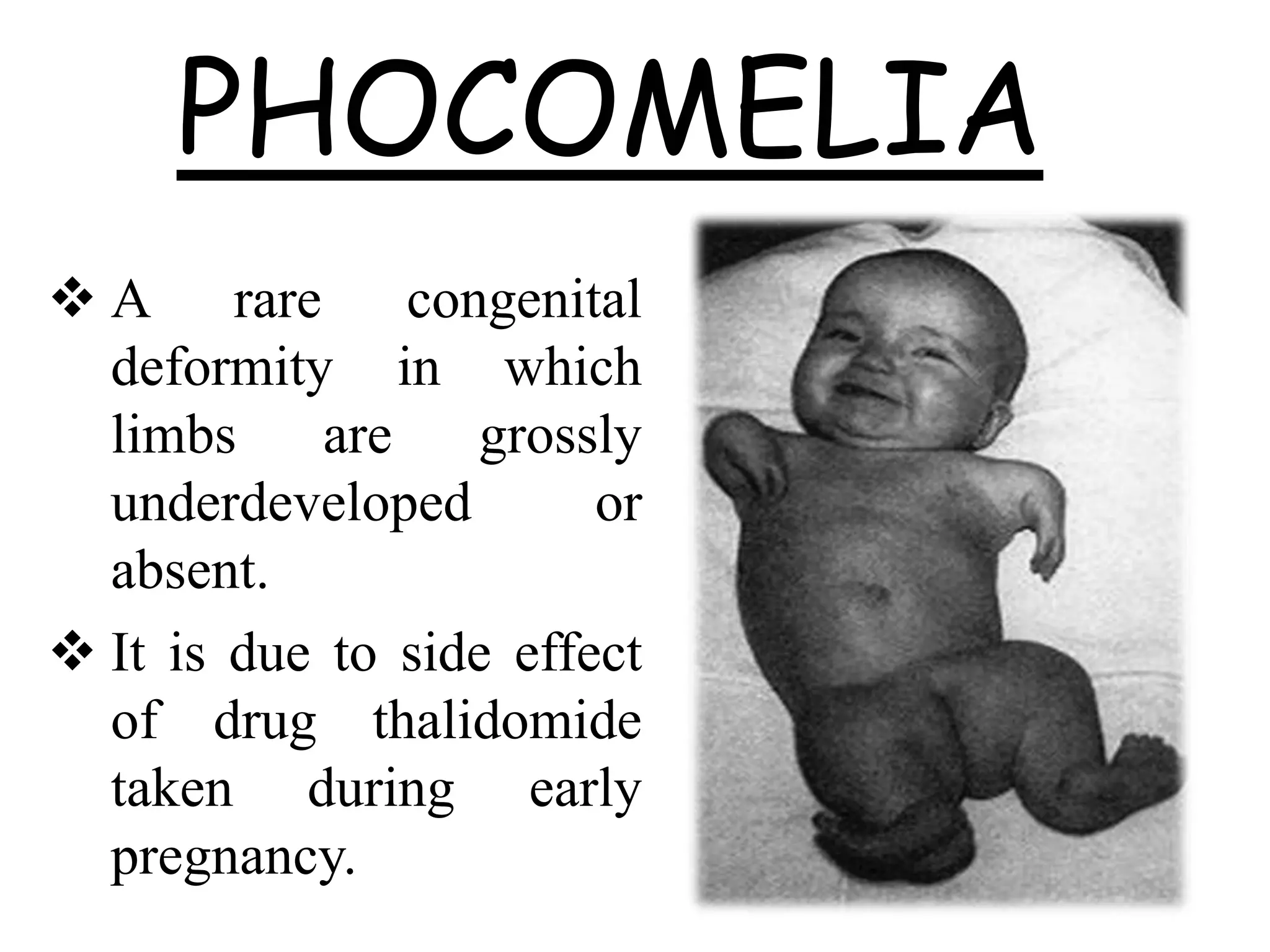 Rare Birth Defects