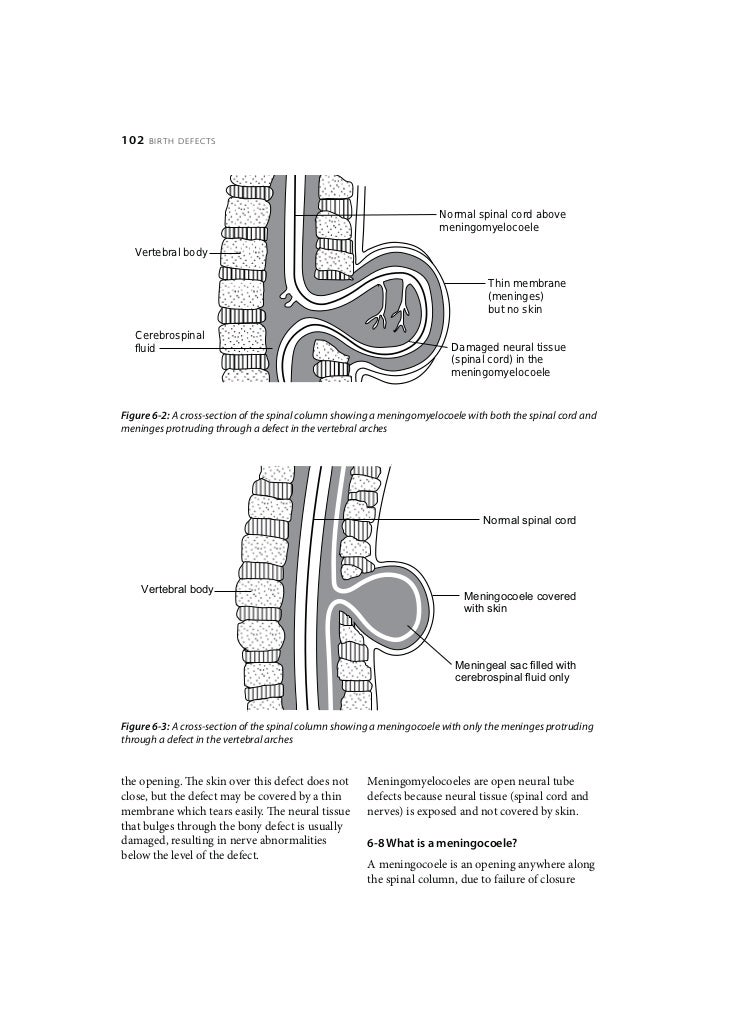 Birth Defects Neural tube defects