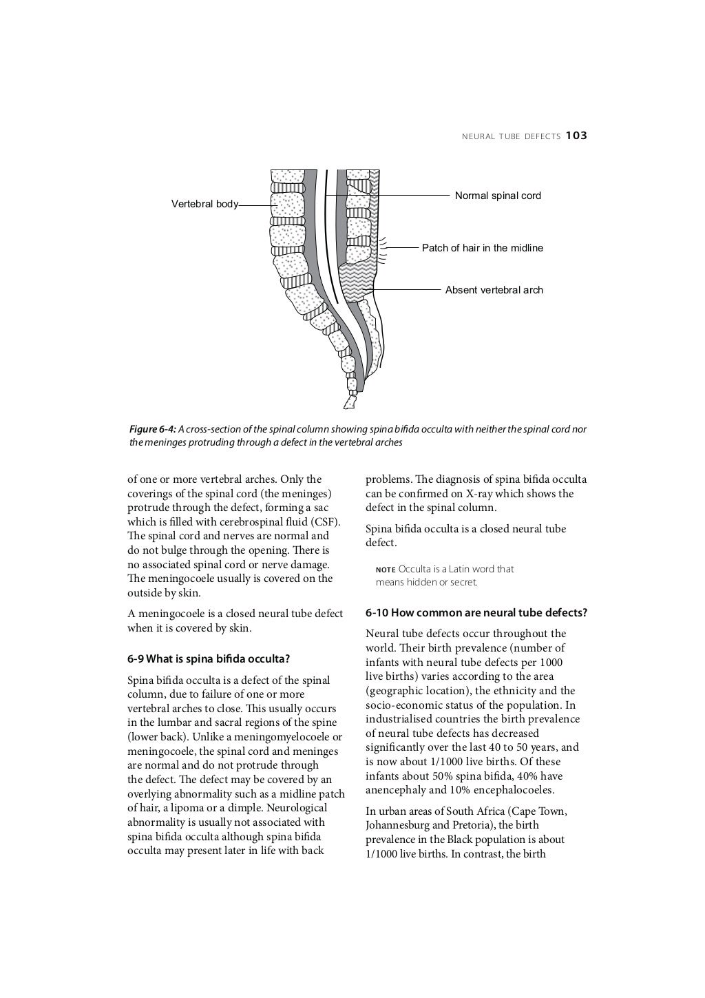 Birth Defects Neural tube defects