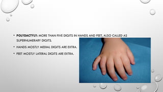 Excess Fingers BIRTH DEFECTS OF LIMBS by Dr. Rabia Inam Gandapore.pptx