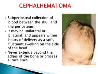  Subperiosteal collection of
blood between the skull and
the periosteum.
 It may be unilateral or
bilateral, and appears within
hours of delivery as a soft,
fluctuant swelling on the side
of the head.
 Never extends beyond the
edges of the bone or crosses
suture lines
 