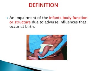  An impairment of the infants body function
or structure due to adverse influences that
occur at birth.
 