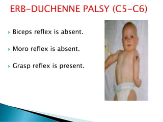 Biceps reflex is absent.
 Moro reflex is absent.
 Grasp reflex is present.
 