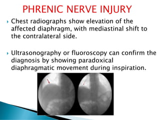  Chest radiographs show elevation of the
affected diaphragm, with mediastinal shift to
the contralateral side.
 Ultrasonography or fluoroscopy can confirm the
diagnosis by showing paradoxical
diaphragmatic movement during inspiration.
 