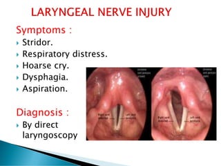 Symptoms :
 Stridor.
 Respiratory distress.
 Hoarse cry.
 Dysphagia.
 Aspiration.
Diagnosis :
 By direct
laryngoscopy
 