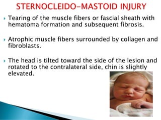  Tearing of the muscle fibers or fascial sheath with
hematoma formation and subsequent fibrosis.
 Atrophic muscle fibers surrounded by collagen and
fibroblasts.
 The head is tilted toward the side of the lesion and
rotated to the contralateral side, chin is slightly
elevated.
 