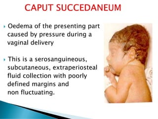  Oedema of the presenting part
caused by pressure during a
vaginal delivery
 This is a serosanguineous,
subcutaneous, extraperiosteal
fluid collection with poorly
defined margins and
non fluctuating.
 