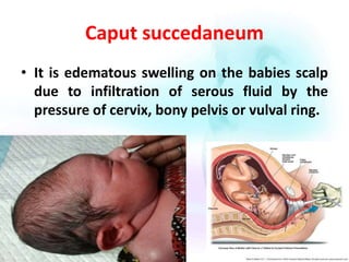 Birth injuries | PPTX