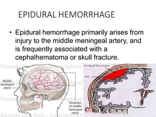EPIDURAL HEMORRHAGE
• Epidural hemorrhage primarily arises from
injury to the middle meningeal artery, and
is frequently associated with a
cephalhematoma or skull fracture.
 