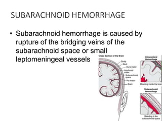 SUBARACHNOID HEMORRHAGE
• Subarachnoid hemorrhage is caused by
rupture of the bridging veins of the
subarachnoid space or small
leptomeningeal vessels
 