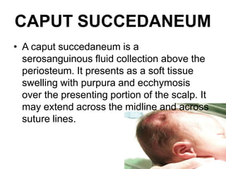 CAPUT SUCCEDANEUM
• A caput succedaneum is a
serosanguinous fluid collection above the
periosteum. It presents as a soft tissue
swelling with purpura and ecchymosis
over the presenting portion of the scalp. It
may extend across the midline and across
suture lines.
 