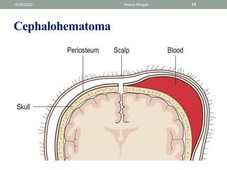 Cephalohematoma
12/26/2022 Reena Bhagat 11
 