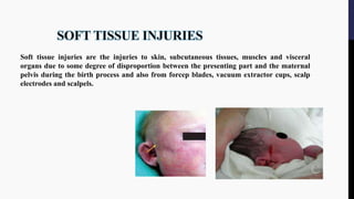Soft tissue injuries are the injuries to skin, subcutaneous tissues, muscles and visceral
organs due to some degree of disproportion between the presenting part and the maternal
pelvis during the birth process and also from forcep blades, vacuum extractor cups, scalp
electrodes and scalpels.
 