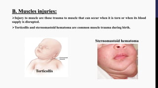 B. Muscles injuries:
Injury to muscle are those trauma to muscle that can occur when it is torn or when its blood
supply is disrupted.
Torticollis and sternomastoid hematoma are common muscle trauma during birth.
Sternomastoid hematoma
Torticollis
 