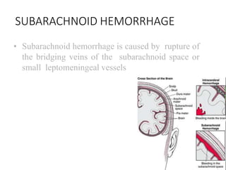 SUBARACHNOID HEMORRHAGE
• Subarachnoid hemorrhage is caused by rupture of
the bridging veins of the subarachnoid space or
small leptomeningeal vessels
 