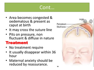 Cont…
• Area becomes congested &
oedematous & present as
caput at birth
• It may cross the suture line
• Pits on pressure, non
fluctuant & diffuse in nature
Treatment
• No treatment require
• It usually disappear within 36
hour
• Maternal anxiety should be
reduced by reassurance.
 