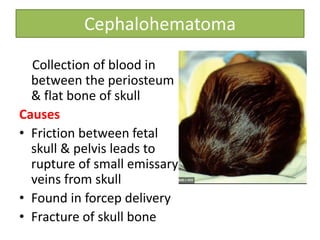 Cephalohematoma
Collection of blood in
between the periosteum
& flat bone of skull
Causes
• Friction between fetal
skull & pelvis leads to
rupture of small emissary
veins from skull
• Found in forcep delivery
• Fracture of skull bone
 