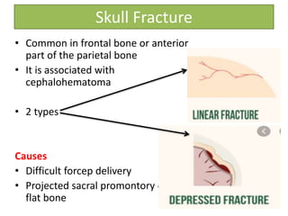 Skull Fracture
• Common in frontal bone or anterior
part of the parietal bone
• It is associated with
cephalohematoma
• 2 types
Causes
• Difficult forcep delivery
• Projected sacral promontory of the
flat bone
 