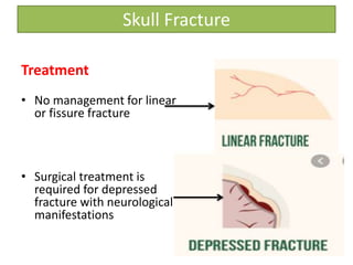 Treatment
• No management for linear
or fissure fracture
• Surgical treatment is
required for depressed
fracture with neurological
manifestations
Skull Fracture
 