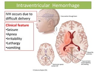 Intraventricular Hemorrhage
IVH occurs due to
difficult delivery
Clinical feature
•Seizure
•Apnea
•Irritability
•Lethargy
•vomiting
 