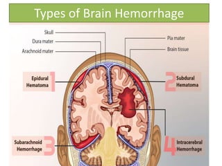 Types of Brain Hemorrhage
 