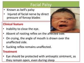 Facial Palsy
• Known as bell’s palsy
• Injured of facial nerve by direct
pressure of forcep blades
Clinical feature
• Inability to close the eye.
• Absent of rooting reflex on the affected side.
• On crying, the angle of mouth is drawn over the
unaffected side.
• Sucking reflex remains unaffected.
Treatment
• Eye should be protected with antiseptic ointment, as
they remain open, even during sleep
 