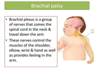 • Brachial plexus is a group
of nerves that comes the
spinal cord in the neck &
travel down the arm
• These nerves control the
muscles of the shoulder,
elbow, wrist & hand as well
as provides feeling in the
arm.
Brachial palsy
 