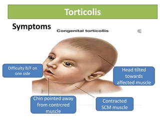 Torticolis
Symptoms
Head tilted
towards
affected muscle
Contracted
SCM muscle
Chin pointed away
from contrcred
muscle
Difficulty B/F on
one side
 