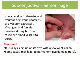 Subconjuctiva Haemorrhage
•It occurs due to stressful and
traumatic deliveries (forceps
or a vacuum extractor).
•Changing and forceful
pressure during birth can
cause eye blood vessels to
burst.
Treatment
•It usually clears up on its own with a few weeks or so
•Some cases, may lead to permanent eye damage (rare).
 