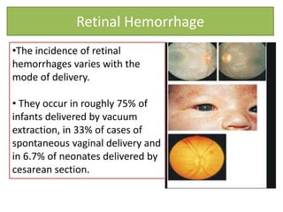 Retinal Hemorrhage
•The incidence of retinal
hemorrhages varies with the
mode of delivery.
• They occur in roughly 75% of
infants delivered by vacuum
extraction, in 33% of cases of
spontaneous vaginal delivery and
in 6.7% of neonates delivered by
cesarean section.
 