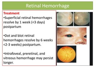 Retinal Hemorrhage
Treatment
•Superficial retinal hemorrhages
resolve by 1 week (<3 days)
postpartum
•Dot and blot retinal
hemorrhages resolve by 6 weeks
<2-3 weeks) postpartum.
•Intrafoveal, preretinal, and
vitreous hemorrhage may persist
longer.
 
