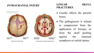 Skull Potential Injuries BIRTH INJURY.pptx