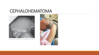 CEPHALOHEMATOMA
 