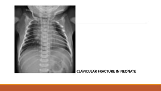 CLAVICULAR FRACTURE IN NEONATE
 