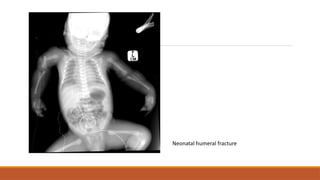 Neonatal humeral fracture
 