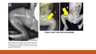FEMUR SHAFT FRACTURE IN NEWBORN
 