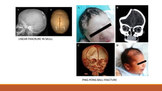 LINEAR FRACRURE IN SKULL
PING PONG BALL FRACTURE
 