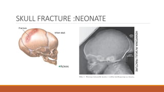 SKULL FRACTURE :NEONATE
HEMATOMA
IN
SKULL
FRACTURE
 