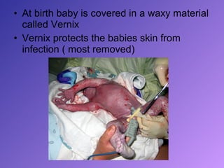 • At birth baby is covered in a waxy material
  called Vernix
• Vernix protects the babies skin from
  infection ( most removed)
 