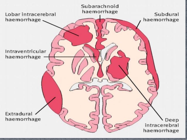 Bleeding in the brain (intracranial bleeding) - Pictures