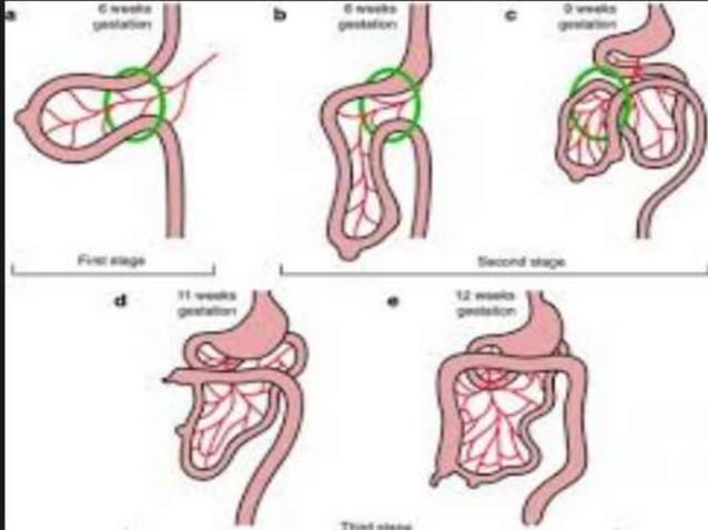 omphalocele and gastroschisis | PPT